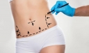 关于吸脂不得不说的秘密 吸脂减肥不适合哪些肥胖人群