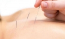 针灸减肥别信这些误区