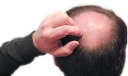男性治脱发易犯的8大误区