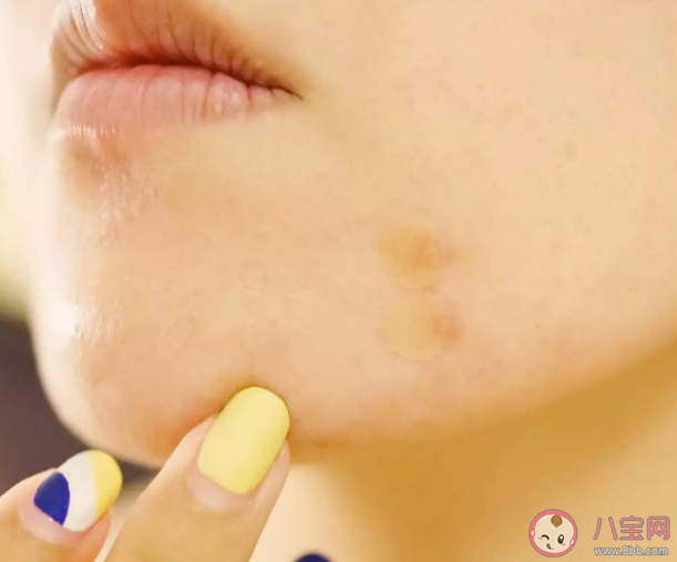 痘痘贴对痘痘有用吗 痘痘贴的作用是什么 痘痘贴对痘痘有用吗 痘痘贴的作用是什么