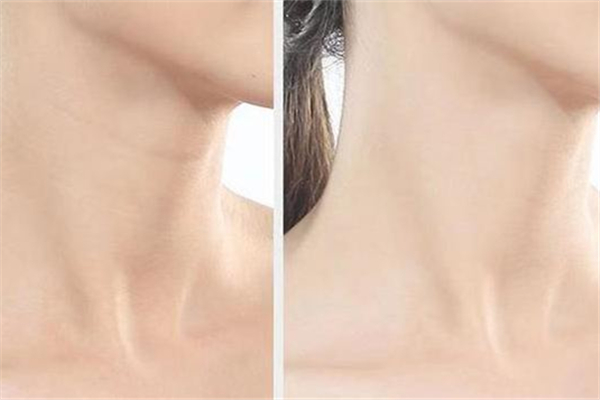 颈纹和胖瘦有关系吗 颈纹是因为胖才有的吗 颈纹和胖瘦有关系吗 颈纹是因为胖才有的吗