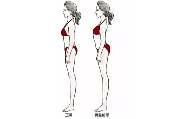 骨盆前倾小肚子会鼓起来吗 骨盆前倾小腹突出怎么矫正 骨盆前倾小肚子会鼓起来吗 骨盆前倾小腹突出怎么矫正