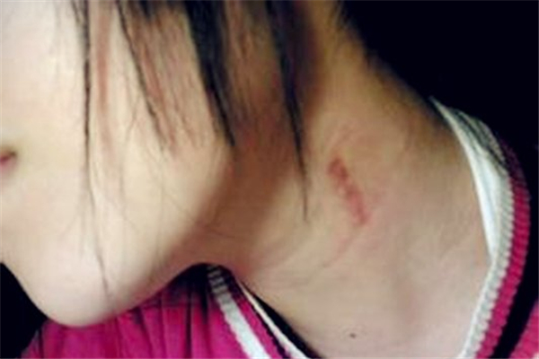 吻痕用鸡蛋热敷管用吗 吻痕用鸡蛋敷过后什么时候能消