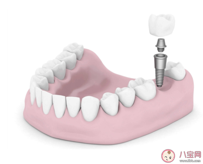为什么种植牙费用这么高 种植牙的费用包括什么