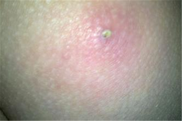 火疖子长屁股上怎么办 火疖子哪里都长吗