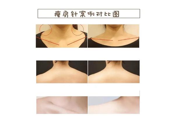 瘦肩针有什么危害和副作用 瘦肩针一针大概多少钱 瘦肩针有什么危害和副作用 瘦肩针一针大概多少钱