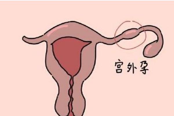 宫外孕试纸能测出来吗 宫外孕hcg值的范围 宫外孕试纸能测出来吗 宫外孕hcg值的范围