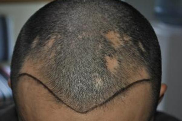 植发是永久性的吗 植发是拆东墙补西墙吗 植发是永久性的吗 植发是拆东墙补西墙吗