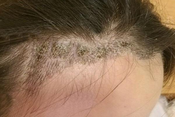 植发是永久性的吗 植发是拆东墙补西墙吗 植发是永久性的吗 植发是拆东墙补西墙吗