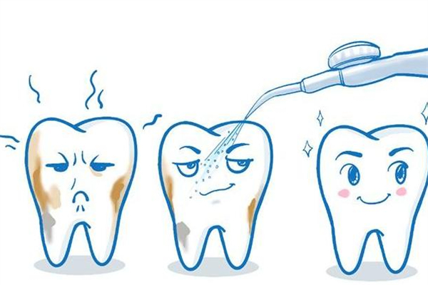 洗牙有必要洗牙根内部吗 洗牙洗的是什么 洗牙有必要洗牙根内部吗 洗牙洗的是什么