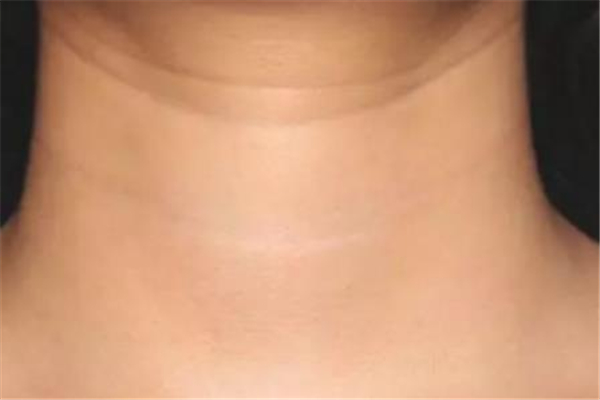 颈纹去除术一般多少钱 颈纹特别深怎么去除 颈纹去除术一般多少钱 颈纹特别深怎么去除