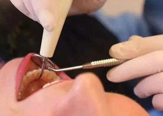 拔牙一次可以拔三颗吗?拔牙拔一侧还是拔双侧好一些