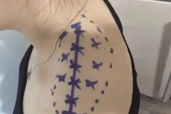 瘦肩针有什么危害和副作用 瘦肩针一针大概多少钱 瘦肩针有什么危害和副作用 瘦肩针一针大概多少钱