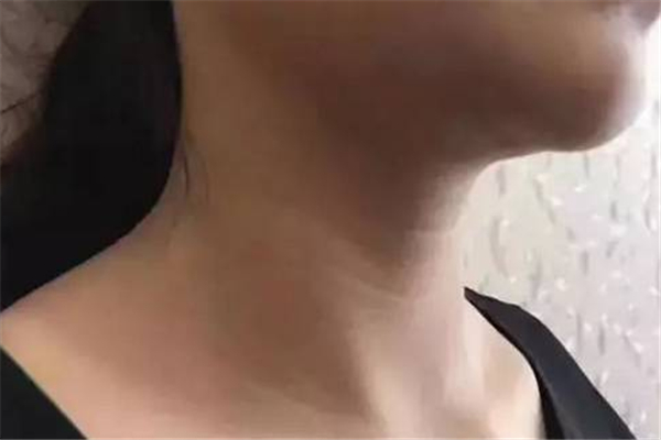 颈纹去除术可以维持多久 颈纹去除术是永久的吗 颈纹去除术可以维持多久 颈纹去除术是永久的吗