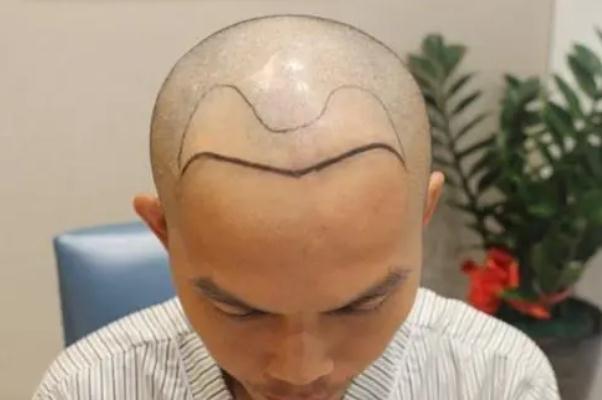 植发是用自己的头发移植吗 植发的危害和后遗症 植发是用自己的头发移植吗 植发的危害和后遗症