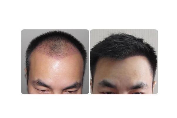 植发要多少钱一般 植发可以维持多久 植发要多少钱一般 植发可以维持多久