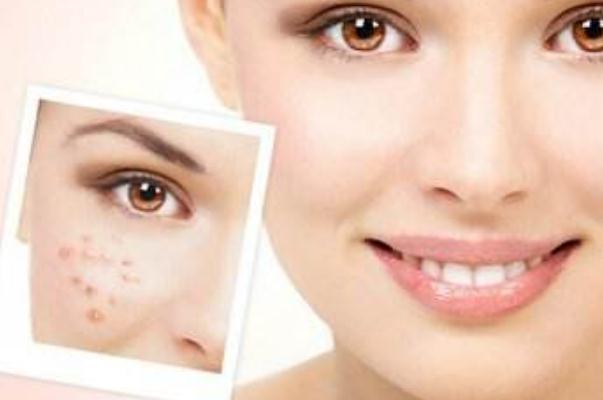 痘痘肌肤要涂防晒吗 痘痘肌是先补水还是先祛痘