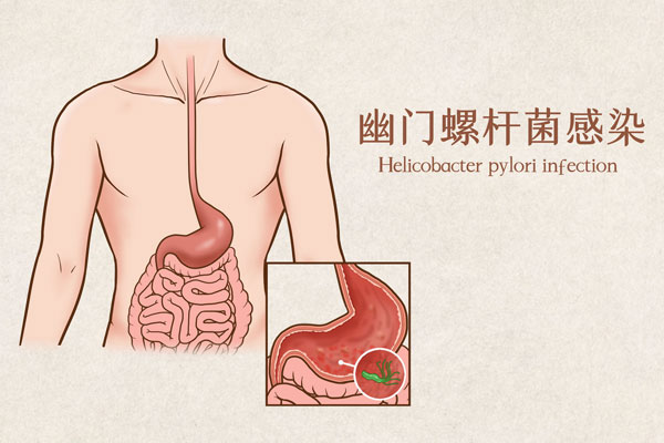 600幽门螺杆菌感染医疗插画（企业商用）.jpg