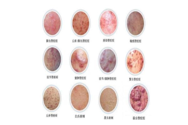 痘痘肌肤怎么修复 痘痘肌肤适合用什么牌子的护肤品