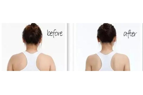 瘦肩针可以维持多久 瘦肩针可以瘦手臂吗 瘦肩针可以维持多久 瘦肩针可以瘦手臂吗