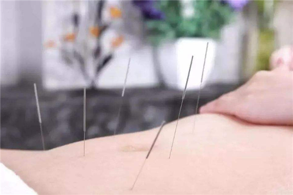 针灸要扎多久 针灸要注意哪些事项 针灸要扎多久 针灸要注意哪些事项
