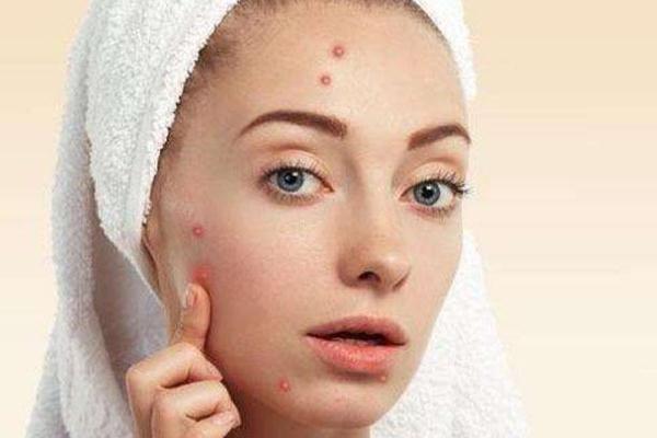痘痘肌肤怎么修复 痘痘肌肤适合用什么牌子的护肤品