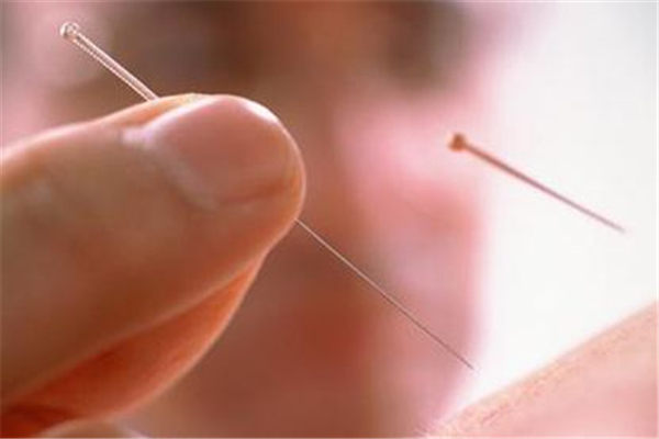 针灸会痛吗 针灸有多疼 针灸会痛吗 针灸有多疼