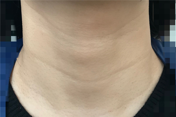 颈纹去除术可以维持多久 颈纹去除术是永久的吗 颈纹去除术可以维持多久 颈纹去除术是永久的吗