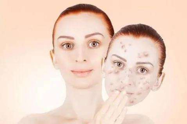 黄瓜敷脸能去黄褐斑吗 白醋洗脸可以去除黄褐斑吗 黄瓜敷脸能去黄褐斑吗 白醋洗脸可以去除黄褐斑吗