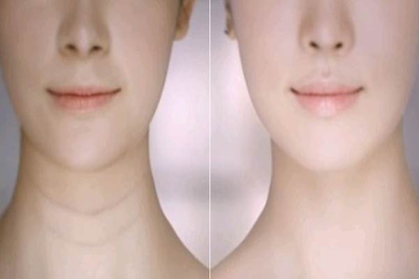 颈纹可以永久去除吗 颈纹可以打玻尿酸吗 颈纹可以永久去除吗 颈纹可以打玻尿酸吗