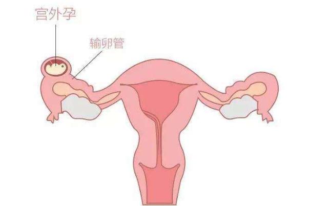 宫外孕的症状有哪些表现 宫外孕怎么办处理方法 宫外孕的症状有哪些表现 宫外孕怎么办处理方法