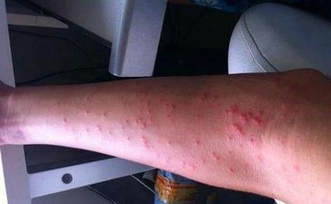 什么样的红点是艾滋病?艾滋病一开始的皮肤是怎样的图片