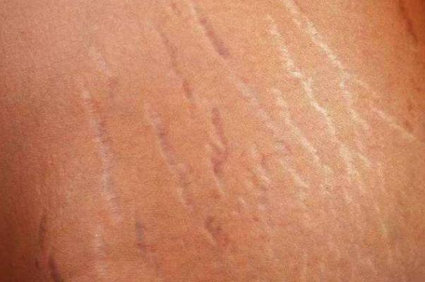 肥胖纹是横的还是竖的 肥胖纹要多久才能完全消除吗