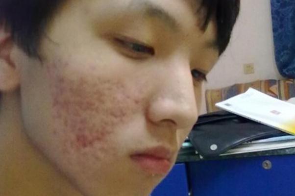 青春痘怎么快速消除 青春痘一般多久会消失 青春痘怎么快速消除 青春痘一般多久会消失