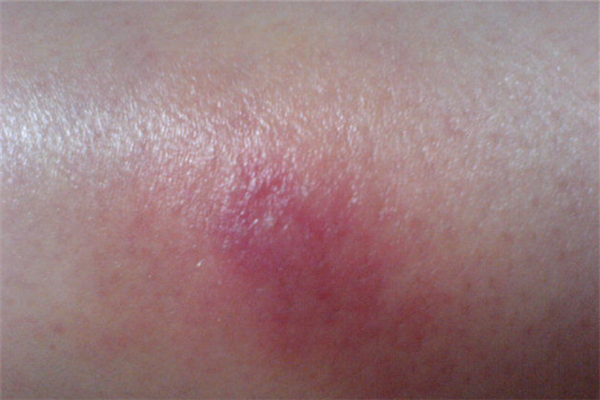 火疖子会复发吗 火疖子为什么反复长 火疖子会复发吗 火疖子为什么反复长