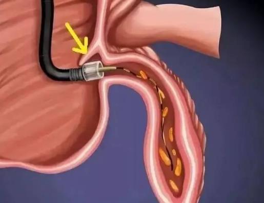 饭后多久可以运动才不会得阑尾炎?阑尾在左边还是右边