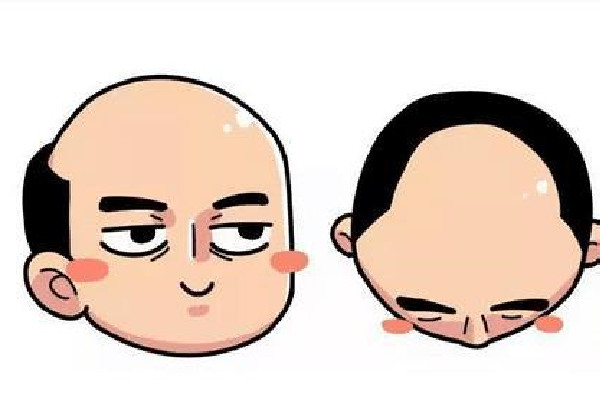 植发用的是哪里的毛囊 植发会不会有什么副作用 植发用的是哪里的毛囊 植发会不会有什么副作用