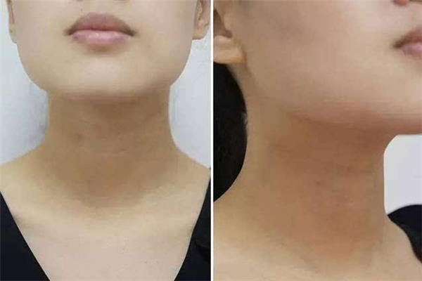 颈纹和胖瘦有关系吗 颈纹是因为胖才有的吗 颈纹和胖瘦有关系吗 颈纹是因为胖才有的吗