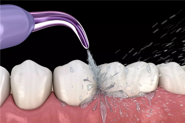 洗牙去医院好还是去牙科诊所好 洗牙有几种方法 洗牙去医院好还是去牙科诊所好 洗牙有几种方法
