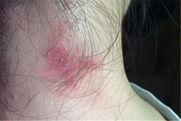 火疖子会复发吗 火疖子为什么反复长 火疖子会复发吗 火疖子为什么反复长