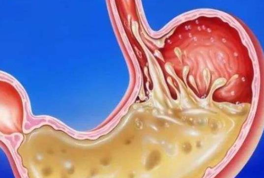 一吃完饭就想拉屎怎么办?一吃完饭就想拉屎应该吃什么药