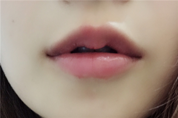 丰唇有多疼 丰唇要注意什么