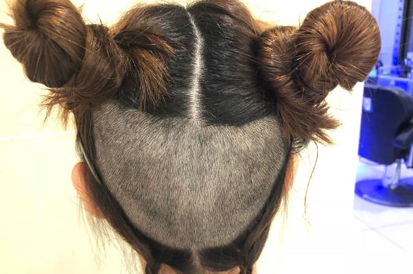 植发是永久性的吗 植发是拆东墙补西墙吗 植发是永久性的吗 植发是拆东墙补西墙吗