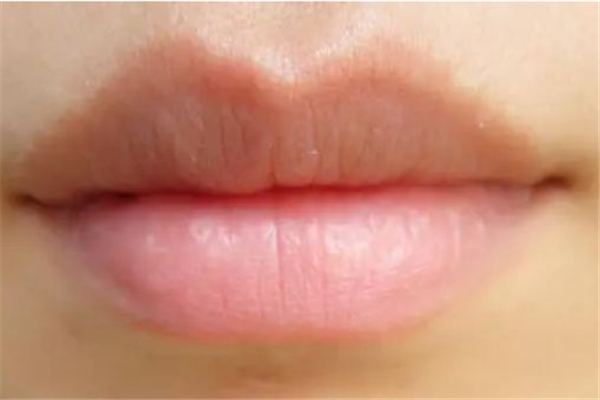 丰唇可以吃消炎药吗 丰唇吃什么食物 丰唇可以吃消炎药吗 丰唇吃什么食物