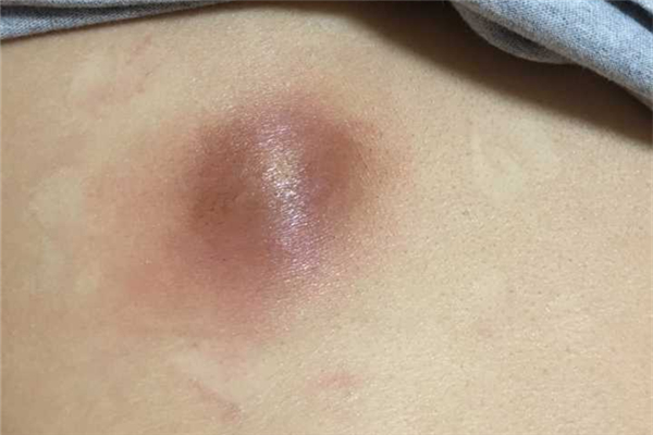 火疖子会复发吗 火疖子为什么反复长 火疖子会复发吗 火疖子为什么反复长