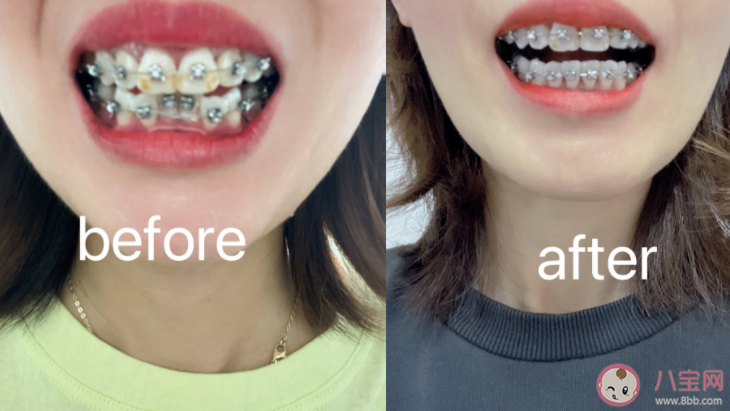 戴牙套真的可以变好看吗 隐形牙套和钢牙套到底哪个比较好 戴牙套真的可以变好看吗 隐形牙套和钢牙套到底哪个比较好