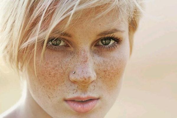 雀斑去除一般要多少钱 雀斑和黄褐斑有什么区别 雀斑去除一般要多少钱 雀斑和黄褐斑有什么区别