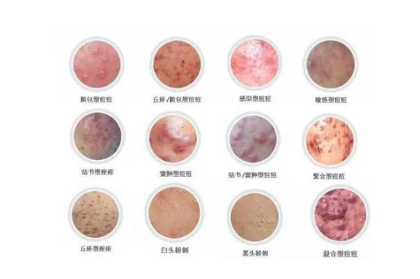 青春痘怎么快速消除 青春痘一般多久会消失 青春痘怎么快速消除 青春痘一般多久会消失