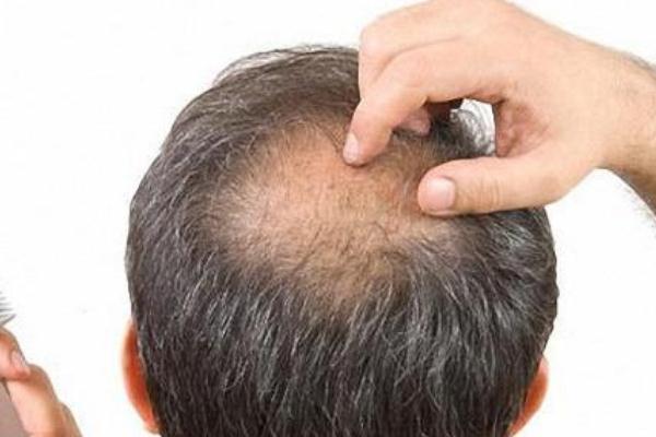 植发要多少钱一般 植发可以维持多久 植发要多少钱一般 植发可以维持多久