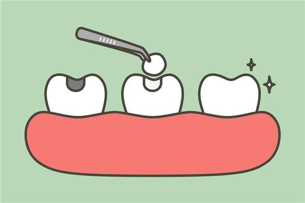 补牙多少钱一颗 补牙要注意什么 补牙多少钱一颗 补牙要注意什么